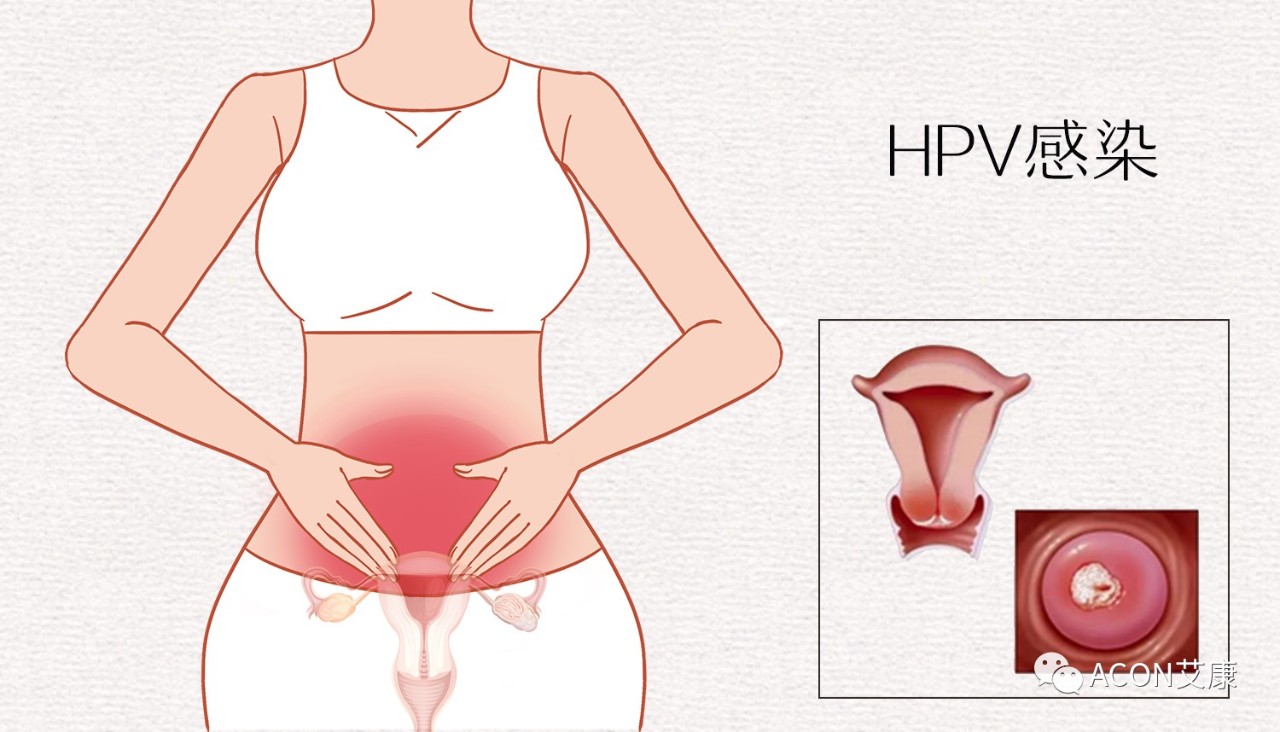 HPV轉(zhuǎn)陰其實(shí)很簡(jiǎn)單， 女性必知的宮頸癌真相