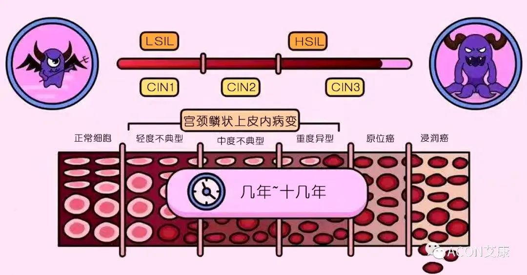 HPV轉(zhuǎn)陰其實(shí)很簡(jiǎn)單， 女性必知的宮頸癌真相