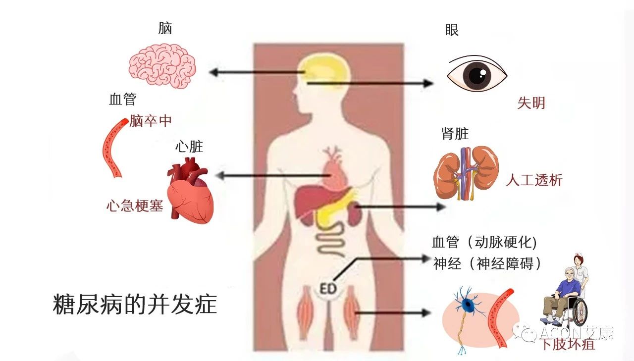 爆上熱搜，因爆發(fā)型糖尿病進入ICU，有哪些教訓(xùn)值得我們汲取