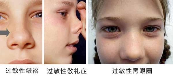 過敏性鼻炎會讓孩子變傻？！家長該如何應對